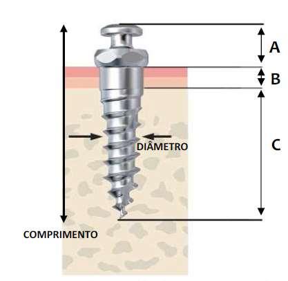 28 possui uma canaleta circunferencial e uma perfuração transversal que permite a ativação ortodôntica.