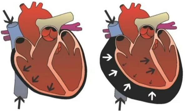 Imagem 6 Dinâmica do retalho costal móvel Tamponamento cardíaco Resulta do acúmulo de sangue no pericárdio, comprimindo o coração e comprometendo o enchimento das cavidades cardíacas.