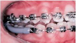 18 anterior, favorecendo a correção da desarmonia entre as arcadas dentárias.