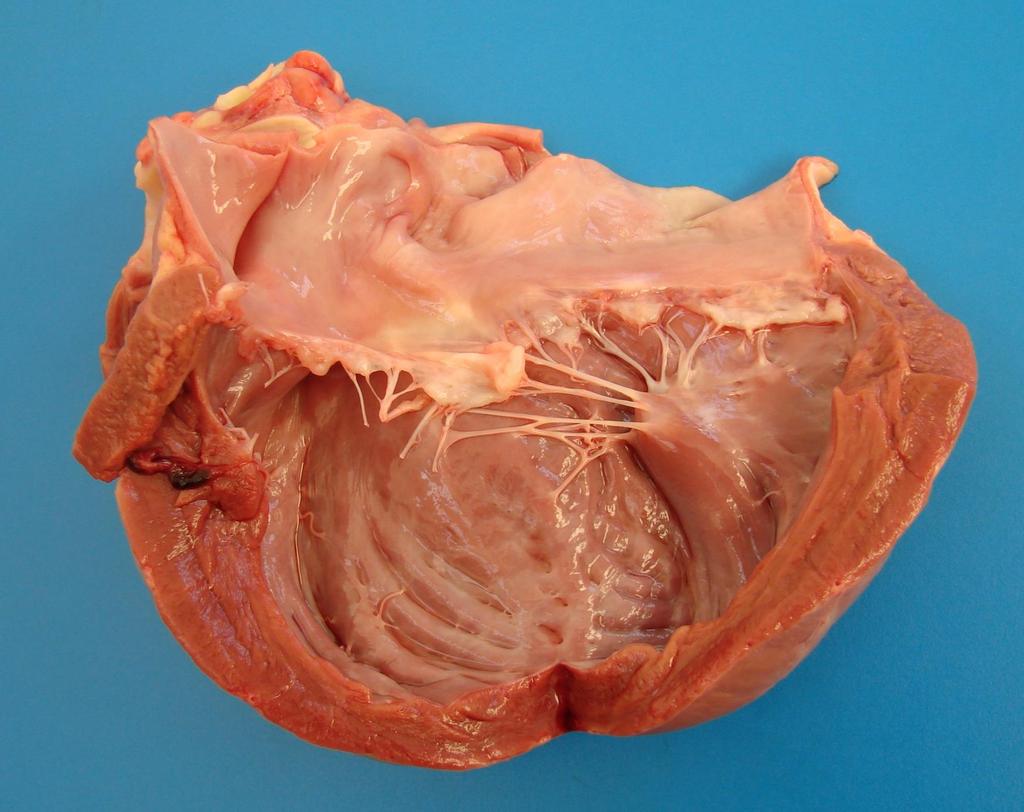 Miocardiopatia