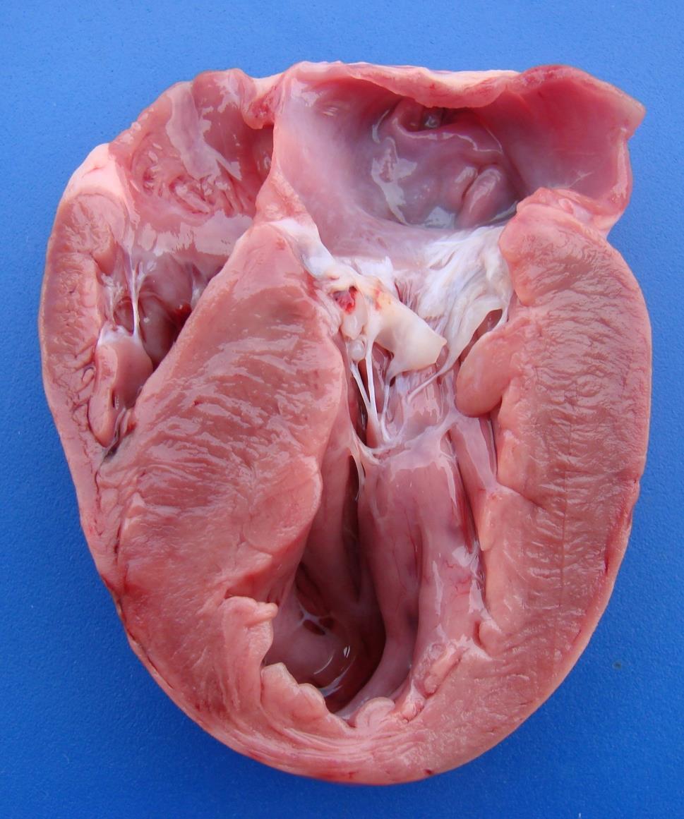 Miocardiopatia