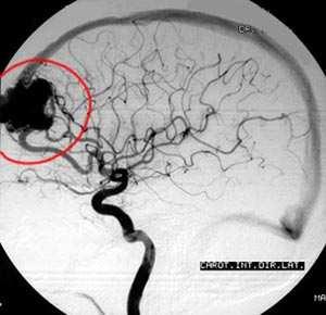 Angiografia Cerebral É um procedimento no qual injeta-se contraste numa artéria, geralmente a carótida,