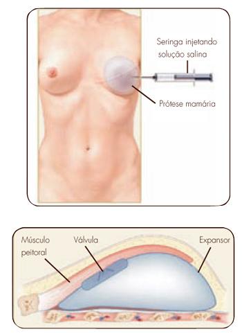 VANTAGENS Procedimento rápido Melhor cobertura da prótese Maior previsibilidade de resultados Menor tempo de