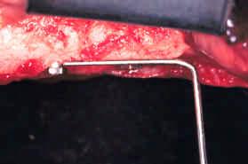 4 - Colocação dos cicatrizadores Decorridos 90 dias da implantação, foi realizada uma incisão sobre a crista óssea do rebordo alveolar de maneira a expor os implantes para a colocação dos