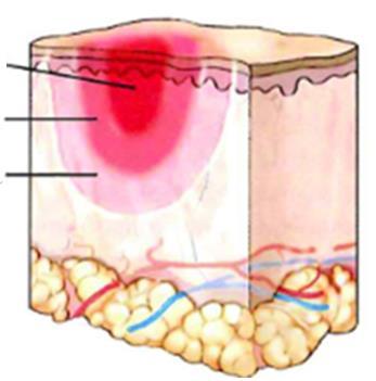 Zonas de lesão por queimadura 1 - Zona de coagulação central, maior destruição tecido morto 2 - Zona de estase menor lesão, células lesionadas porém de modo reversível dependem da ressuscitação