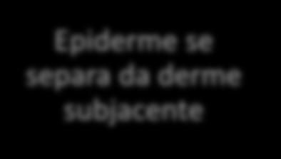 O que fazer com a bolha/ flictena da