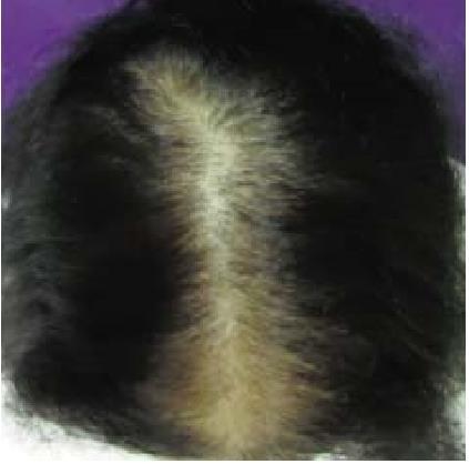11 da cobertura do couro cabeludo não se deve à destruição de folículos pilosos, mas sim ao referido processo de miniaturização (LOBO et al 2008.; BRENNER et al. 2011).
