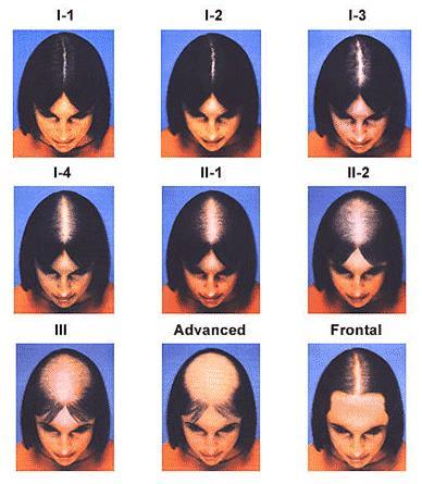 12 Na literatura existem algumas classificações distintas da Alopecia Androgenética.