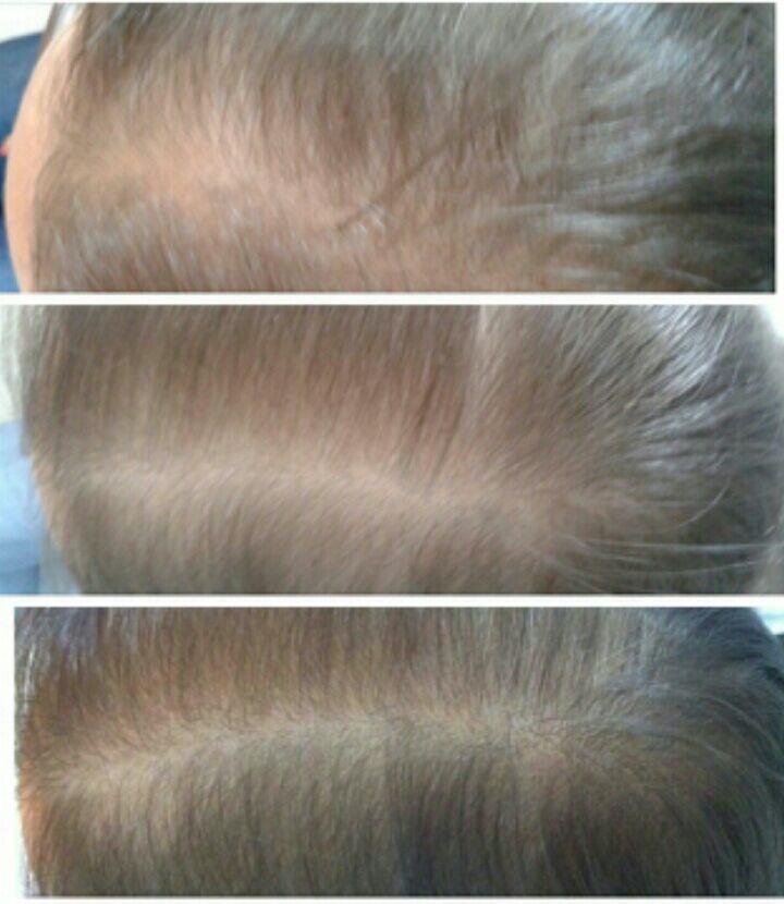 17 Figura 6: Resultado da aplicação de Carboxiterapia para alopecia (a. inicial, b. após 8 sessões, c. após 19 sessões) Fonte: a autora do trabalho.