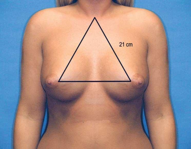 12 INTRODUÇÃO A aparência normal da mama na mulher é vital para uma forma feminina. Por outro lado, essa normalidade é muito subjetiva, variando em cada paciente.