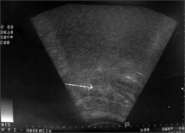 Após a administração de contraste intravenoso podíamos constatar a ausência de realce dos segmentos ileais Fig 2b - Ecografia: fina lâmina de derrame peritoneal (seta).