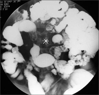 Fig 6 - Laparotomia: ansas de intestino delgado com parede espessada (seta) e ansas com aspecto macroscópico normal (cabeça de seta). Fig 4 - Enteroclise: aumento do espaço interansas (asterisco).