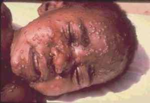 (poucas pústulas). - varíola humana: tipo maligno (muitas pústulas).