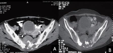 quanto os procedimentos são realizados com contraste iodado, em decúbito dorsal horizontal, utilizando janelas de partes moles e óssea, respectivamente (Fig.