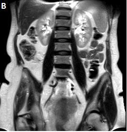 Imagens de RM em T1 têm boa resolução para detecção de infiltração do canal medular, pois o tumor aparece em hiposinal em T1 e hipersinal em T2 (ALMEFTY et al, 2007), mostrando adequadamente, a