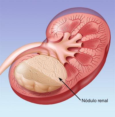 Tumores renais 17/08/2017 - Dra. Marcela Noronha As neoplasias do trato urinário em crianças quase sempre são malignas e localizam-se, em sua maioria, no rim.
