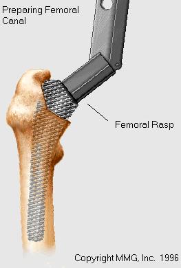 artroplastia total