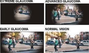 Visão Glaucoma Elevação da pressão intraocular que provoca lesões no