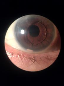 Rosa AAM, Mendes TS, Oliveira Filho PSM Figura 1. Exame de biomicroscopia mostrando lente intraocular de câmara anterior e fragmento do implante de corticoide inferiormente. Figura 2.