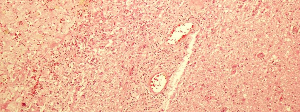 No parênquima adjacente à área necrótica encontrou-se gliose variável e freqüentes nódulos microgliais, em meio aos quais não foi incomum encontrar a forma taquizoíta com o auxílio de