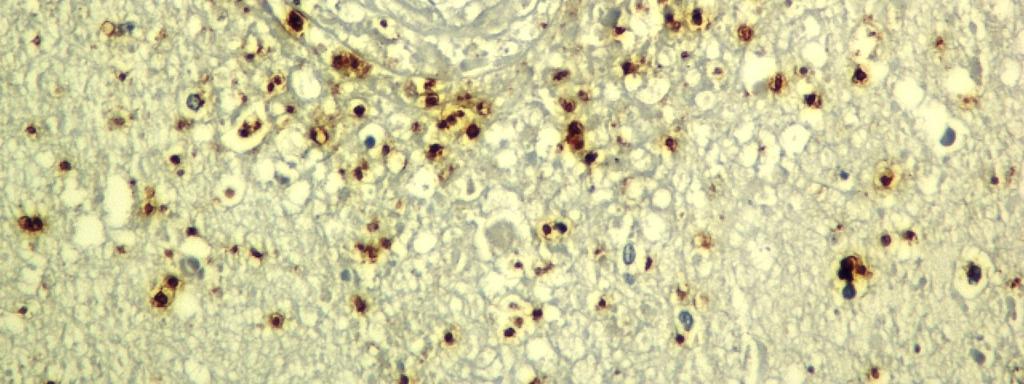 linfócitos (fig. 8). Em apenas um caso observouse processo inflamatório acentuado, de aspecto granulomatoso, composto por inúmeros macrófagos, células gigantes, escassos linfócitos e plasmócitos (fig.