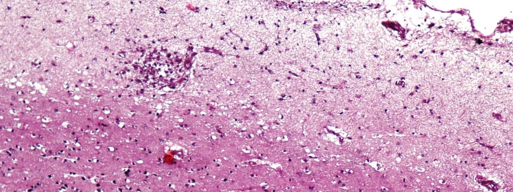 Encefalite nodular microglial caracterizada por nódulos microgliais hipercelulares, constituídos por linfócitos e micróglia (fig.