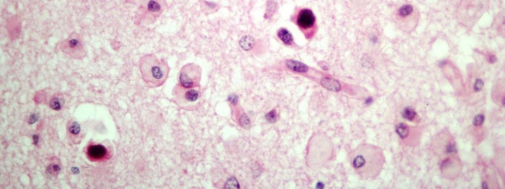17) e fragmentos de mielina no interior de macrófagos. Não foi possível a confirmação imuno-histoquímica por não possuirmos o anticorpo para tal vírus.