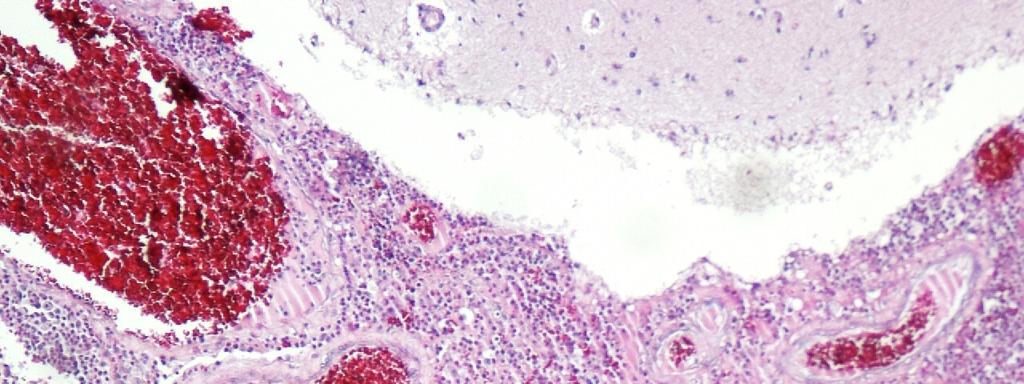 Meningite purulenta: observada em dois casos, caracterizada por espessamento das leptomeninges associado a proeminente infiltrado
