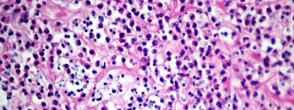 Histoplasmose: vista em apenas 1 caso com padrão de meningoencefalite representada por