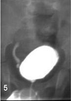 Grau Distrubuição geral* Descrição I 20% Envolvimento parcial do ureter sem atingimento do bacinete, mantendo-se a morfologia do tracto urinário superior.
