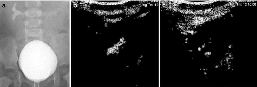 Figura 3 RVU de grau II no rim direito demonstrado por (a) CUMS e (b) urosonografia miccional com contraste, observando-se hiperecogenecidade na pélvis renal.