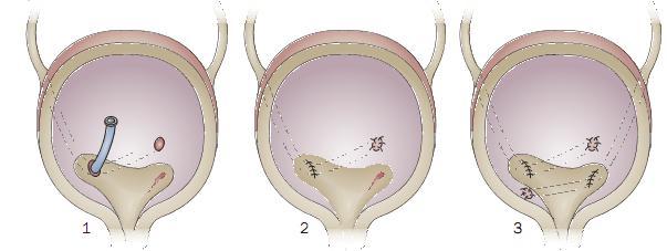 Figura 6 Ilustração esquemática da técnica de Cohen (ureteroneocistostomia de avanço transtrigonal) (adaptado de Cooper et al., 2009).