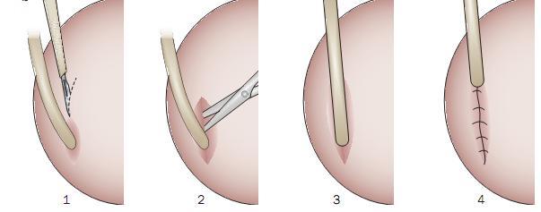 Figura 7 Ilustração esquemática da detrossorrafia de Lich e Gregoir (adaptado de Cooper et al., 2009).