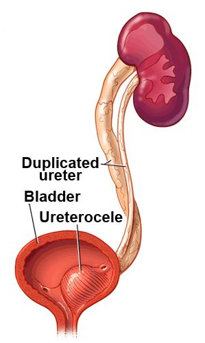 Ultra-som Seguro, não invasivo e barato Alterações significativas do trato urinário, como hidronefrose, dilatação