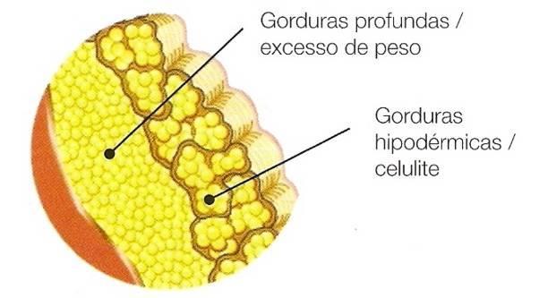 HIPODERME E CELULITE A celulite é o