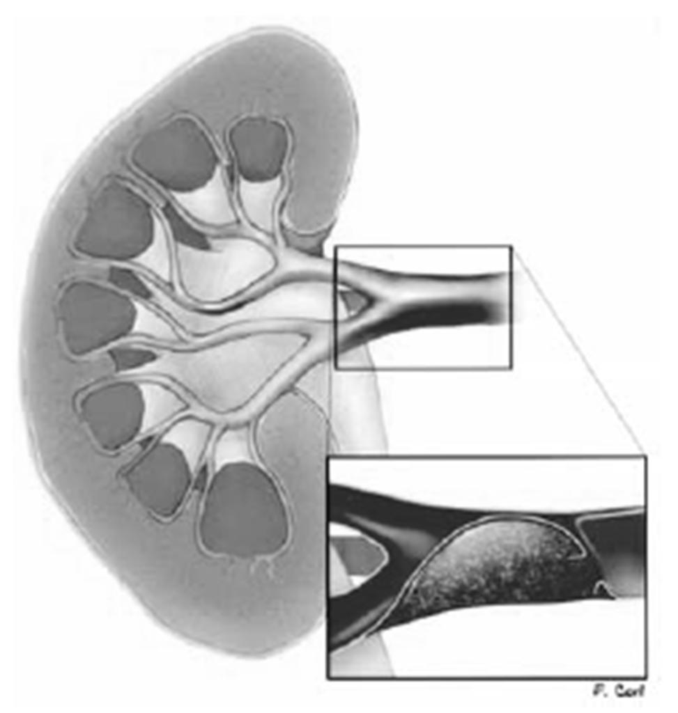Fig. 7 Rim multifracturado. Fig. 8 Avulsão do ureter. As Fig. 7, 8 e 9 representam lesões renais de grau V [51].
