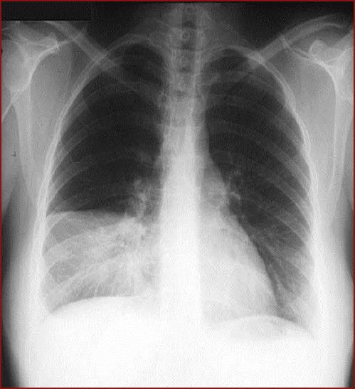 Exames auxiliares de Diagnostico Rx do tórax mostra: Pneumonia lobar observam-se áreas