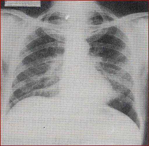 Exames auxiliares de Diagnostico Pneumonias fúngicas padrão micro ou macronodular
