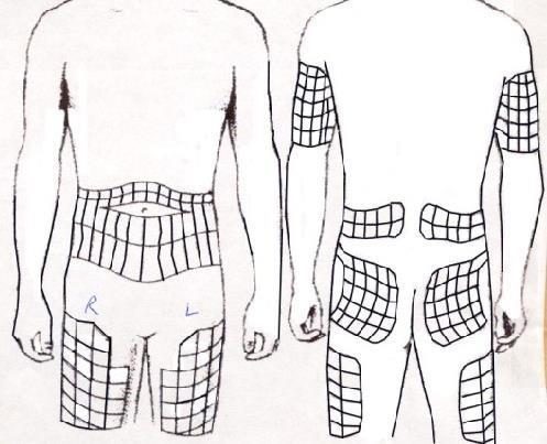 LOCAIS DE APLICAÇÃO: MAPA DE APLICAÇÃO DE INSULINA: Abdômen (barriga); Próximo à cintura; Coxa (frente e lateral externa); Glúteo (parte superior e lateral das nádegas); Braço