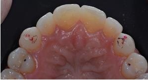 Figura 9. Close-up da superfície oclusal dos dentes superiores, mostrando acréscimo de resina composta na vertente triturante mesial da cúspide do dente 13 e 23. Figura 10.