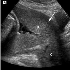 Placenta normal ao Ultrassom
