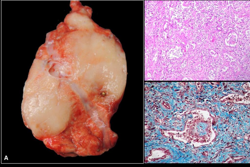 Figure1. A. Equine lung with multinodular pulmonary fibrosis. There are whitish, firm and well-defined nodules that were approximately 7-10 cm in diameter distributed in the parenchyma. B.