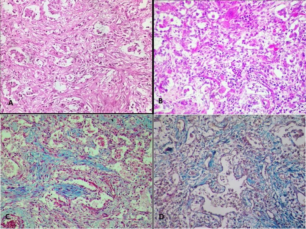 Figure3.A. Histological section of lung shown in Figure 2A. The alveolar spaces show inflammatory cells and connective tissue proliferation. HE 20X B.