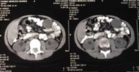 INTRODUÇÃO RESSECÇÃO LAPAROSCÓPICA DE DUPLICIDADE GASTRICA NA INFÂNCIA - RELATO DE CASO LAPAROSCOPIC SURGERY OF GASTRIC DUPLICITY IN INFANCY - CASE REPORT Em 1733, Calder descreveu o primeiro caso