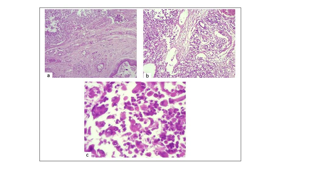 FIGURA 4- Coloração em H.E. a- Proliferação das células neoplásicas adentrando túbulos de glândula mamária (seta). Aumento de 40x.
