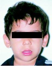 Causas A SAHOS em crianças possui etiologia multifatorial e ocorre devido à associação de fatores obstrutivos estruturais (como a hipertrofia de tonsilas, a laringomalácia, ou malformações