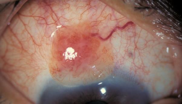 12 Neplasia cnjuntival Sintmas e Sinais: Lesã