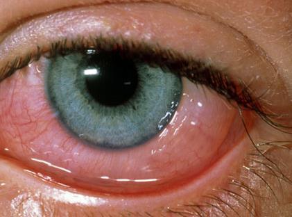 : Etilgia 2 Cnjuntivite Hemrragia subcnjuntival Pingueculite Pterígi inflamad Neplasia cnjuntival Queratite Ersã