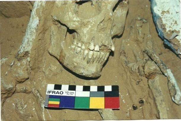 FIGURA 08: Maxilar e mandíbula de um adulto com hipoplasia do esmalte dentário do sítio Justino Fonte: (acervo técnico do MAX).