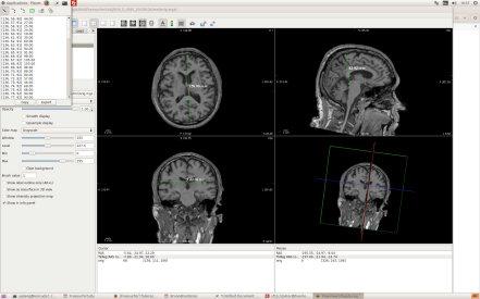 47 As figuras a seguir mostram as imagens de MRI que serviram de referência e o modelo criado a partir delas. Figura 21.